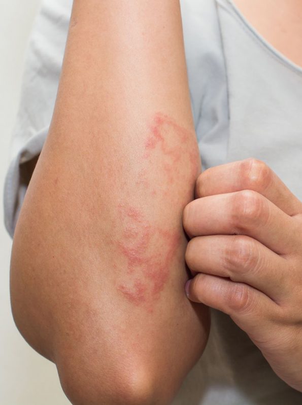 Eczema(1) انواع آلرژیهای پوستی را بشناسید