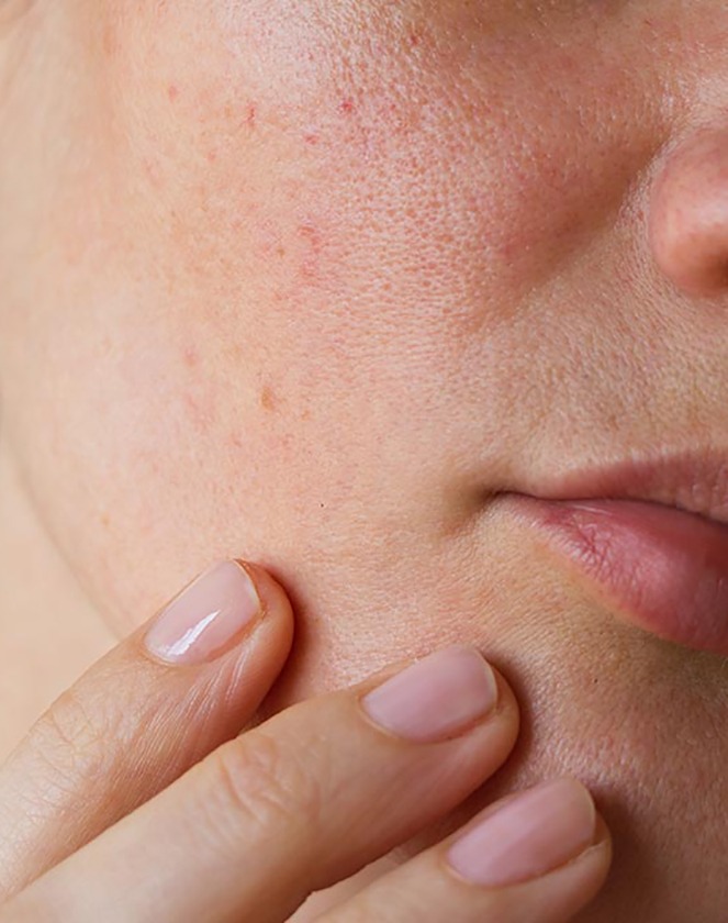 چگونه منافذ باز پوست را درمان و کنترل کنیم