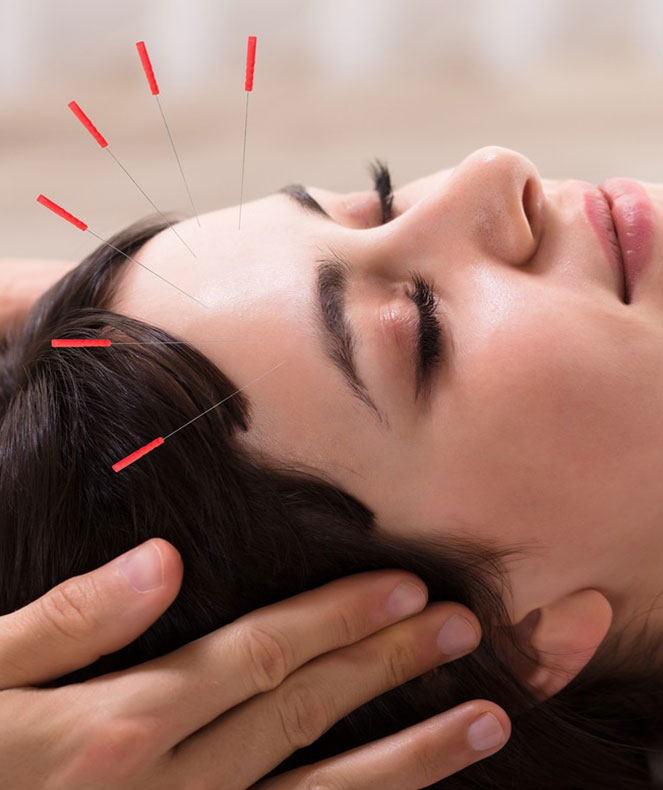 طب سوزنی و ریزش مو