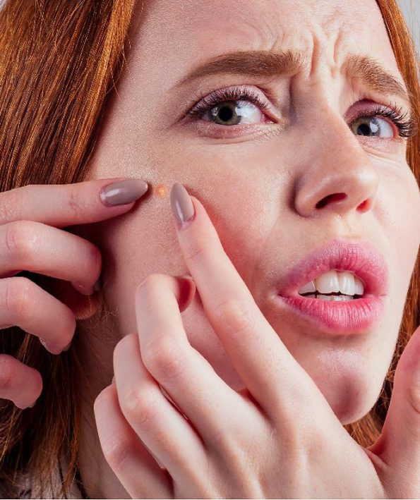 Treatment of all types of pimples1 درمان انواع جوش صورت