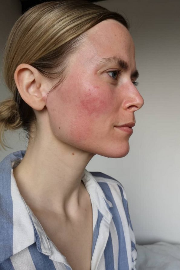 Learn more about dry and sensitive skin در مورد پوست خشک و حساس بیشتر بدانید