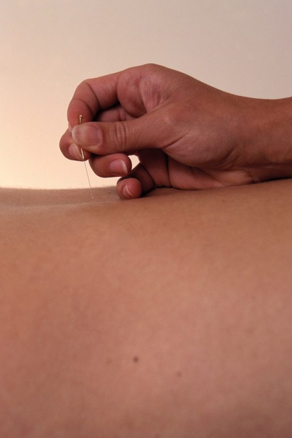 Acupuncture cures drug epidemic1 طب سوزنی برطرف کننده اپیدمی مواد مخدر