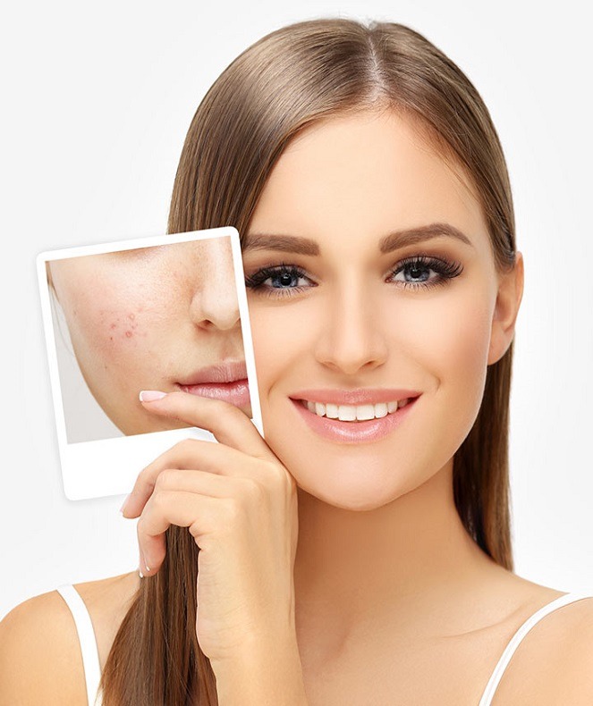 محصولات آرایشی مناسب برای پوست چرب و اکنه ای