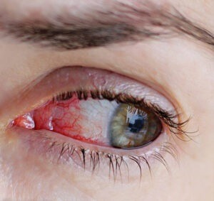 آلرژی های فصل پاییز