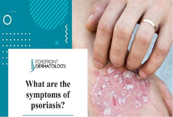 What are the symptoms of psoriasis علائم پسوریازیس چیست
