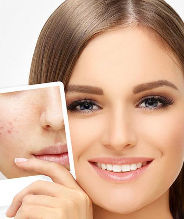Eliminate scars and acne از بین بردن جای اسکار و آکنه