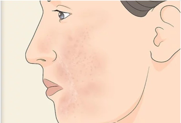  درمان پوست آسیب دیده ناشی از لایه برداری 