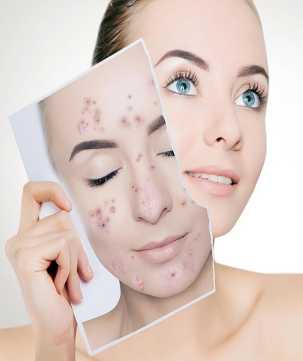 Introducing the best facial cleansers for acne prone skin 111 معرفی بهترین شوینده های صورت برای پوست مستعد جوش