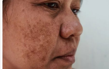 پیشگیری و درمان لکه های پوستی 
