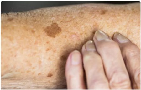 پیشگیری و درمان لکه های پوستی 