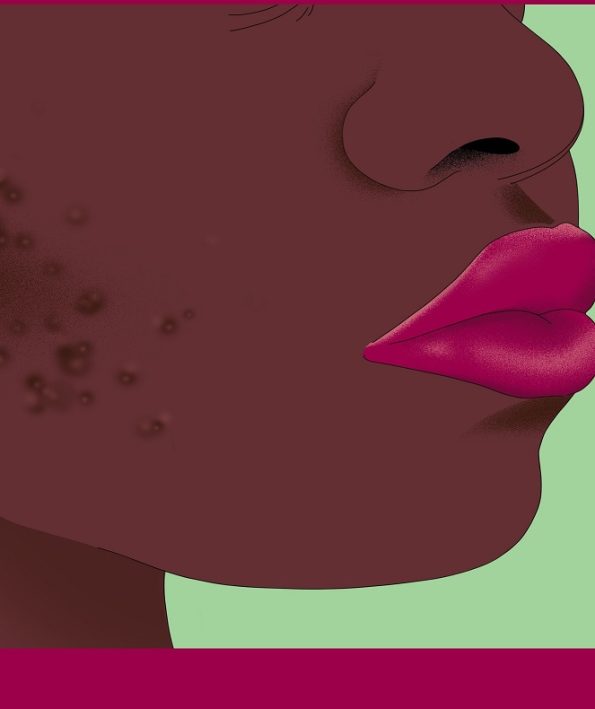 Everything about hyperpigmentation 3 همه چیز راجع به هایپرپیگمنتیشن