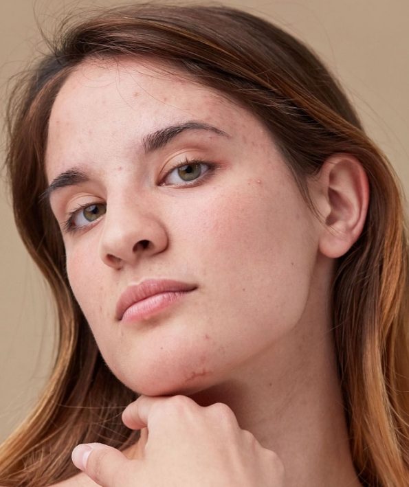 Solution to eliminate pimples and scars 10 راهکار از بین بردن جای جوش و اسکار