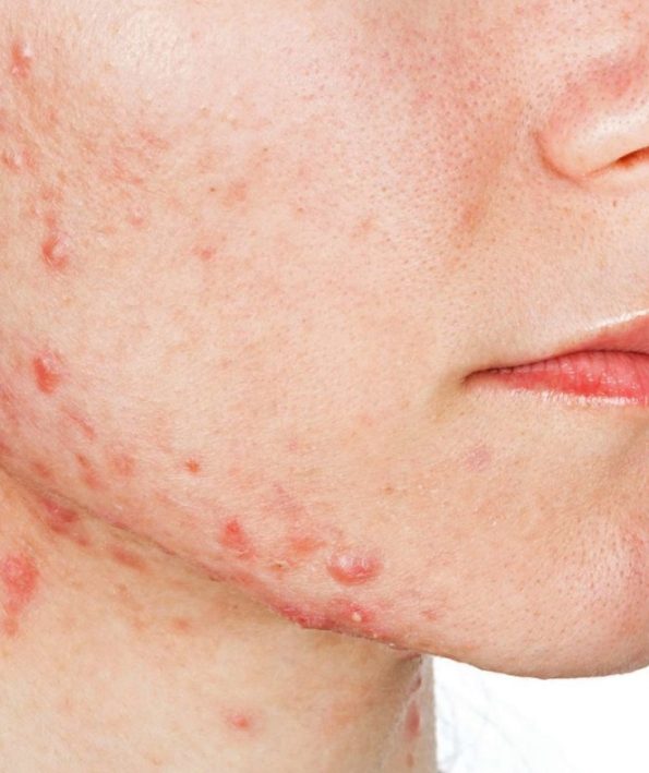 Everything about pimples and acne 6 همه چیز راجع به جوش و آکنه