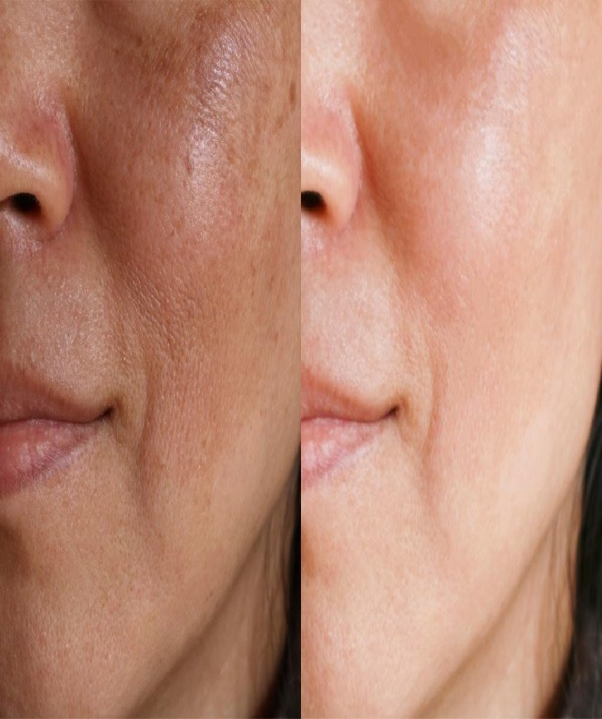 استفاده همزمان از هیدروکینون و آزلائیک اسید