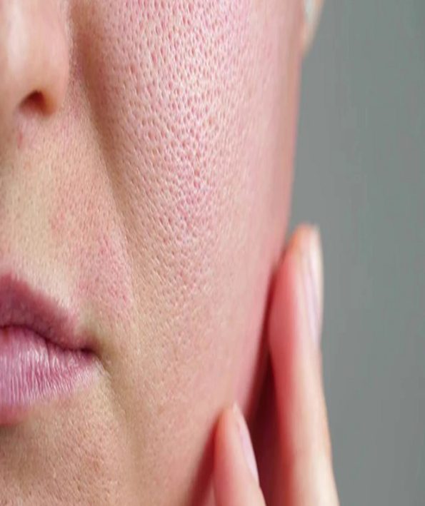 6 روش برای خلاص شدن از شر منافذ بسته پوست